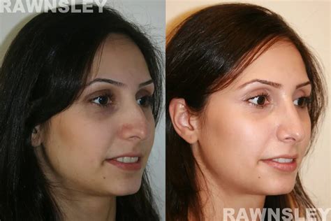 Ethnic Rhinoplasty Before & After | Rawnsley Plastic Surgery