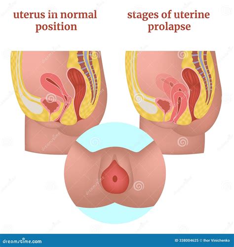 Stages of Uterine Prolapse. Female Reproductive Organs Diagram and