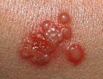 Энгийн херпес хомхойн вирус (Herpes... - Tserensambuu Sharav