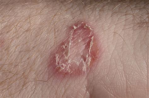 Minor Staph Skin Infection