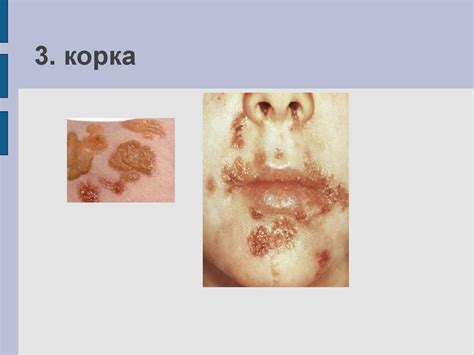 Морфологические элементы сыпи - презентация онлайн