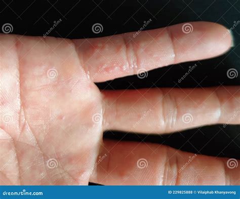 Dyshidrotic Eczema On The Foot. Blister Dermatitis. Treated With ...