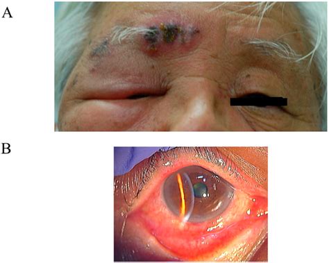 Viral Conjunctivitis Pseudomembrane