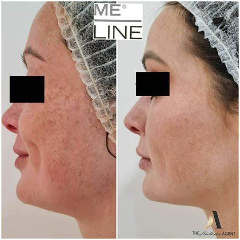 meline peel treatment cape town