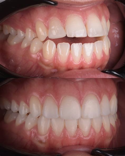 Complex Invisalign case study