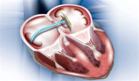 device closure asd pda dr sai teja baratam