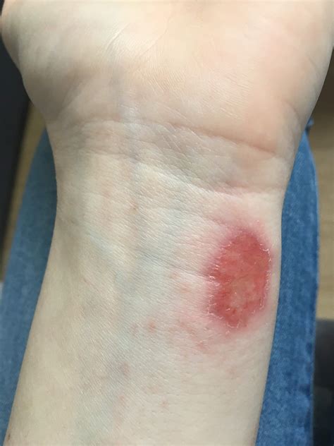 Schürfwunde riecht nach nassem Hund? (Medizin, Arzt, Krankheit)