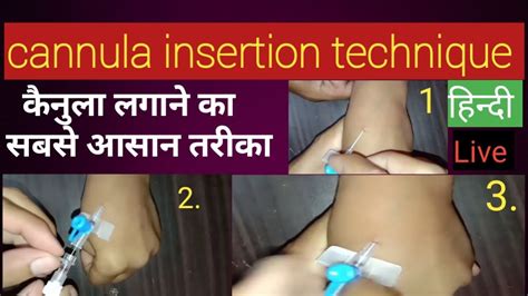 Cannulation Technique (कैनुला) | Cannula Insertion Technique ...