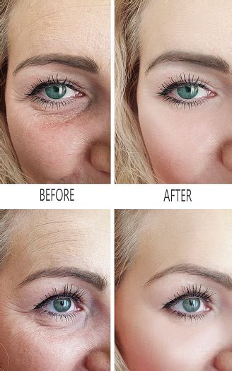 woman wrinkles    procedures stock photo  image