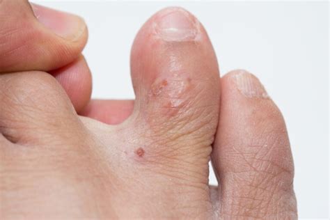 Dyshidrotic Eczema Treatment