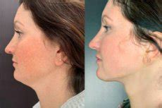Chin lift
