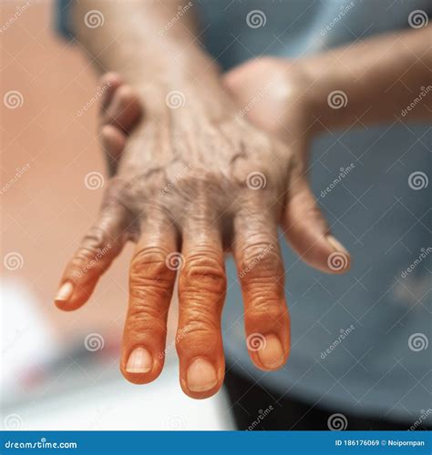 Peripheral Neuropathy Pain In Elderly Patient On Hand, Palm, Fingers