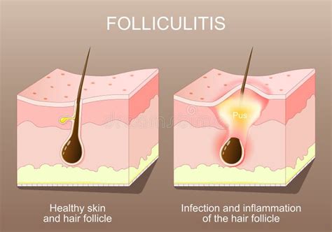 how to treat hair follicle inflammation