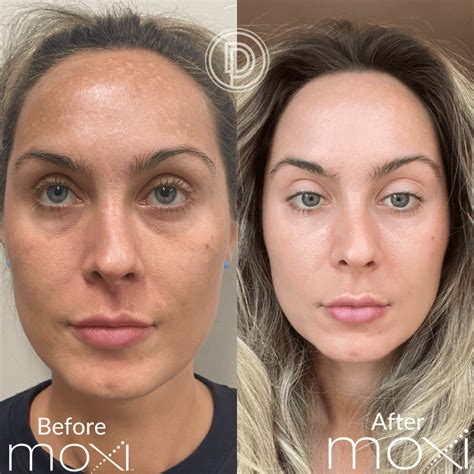 levisa lazer: Before & After Photos That Will Amaze You - whqje74