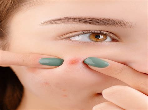 Does Steaming Help Blind Pimples at Marvin Baird blog