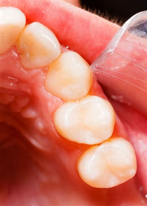 Gum Disease Prevention: Root Planing and Scaling - Mitchell Dental Spa