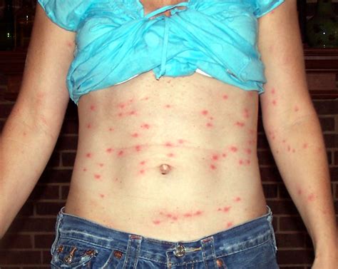 Chigger Bites: Pictures and Treatment