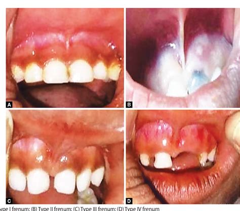 maxillary labial frenum semantic scholar
