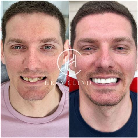 crown teeth    pictures