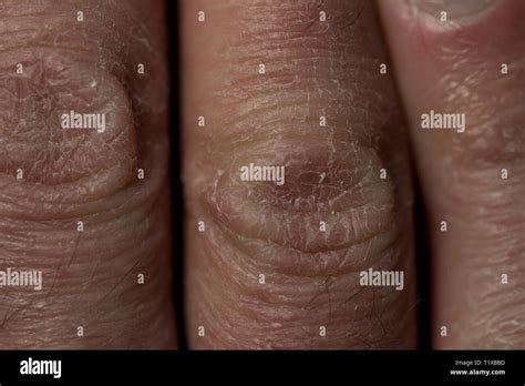 dry skin close  knuckles  scaling dry skin damage eczema dry
