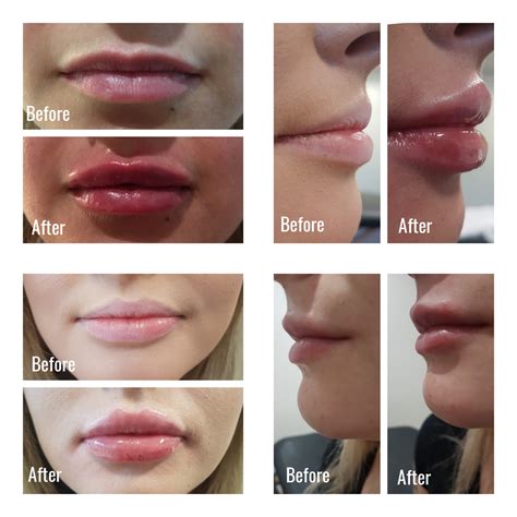 Dermal Fillers | Lip Fillers | Jawline | Cheeks | Rhinoplasty