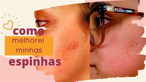 O Que Fazer Para Espinha Sumir - COMO MINHAS ESPINHAS SUMIRAM EM 2 DIAS! | MARCELLA KOVACS - YouTube