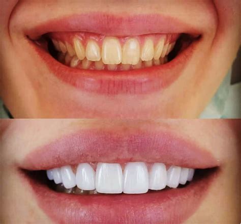 Veneers | Cosmetic teeth, Cosmetic dentistry veneers, Veneers teeth