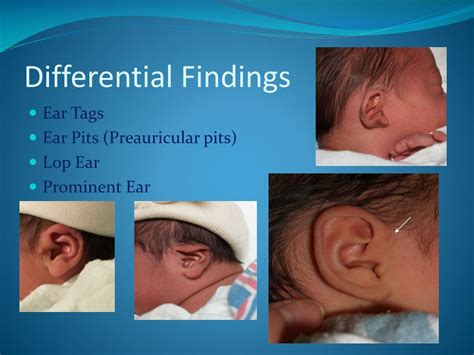 neonatal gestational age assessment powerpoint