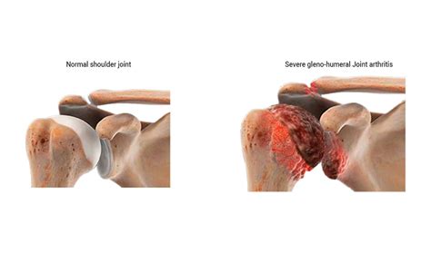 Shoulder Arthritis Treatment – Queensland Orthopaedic Clinic