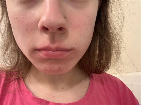 Butterfly On Face Lupus at Nichelle Hock blog