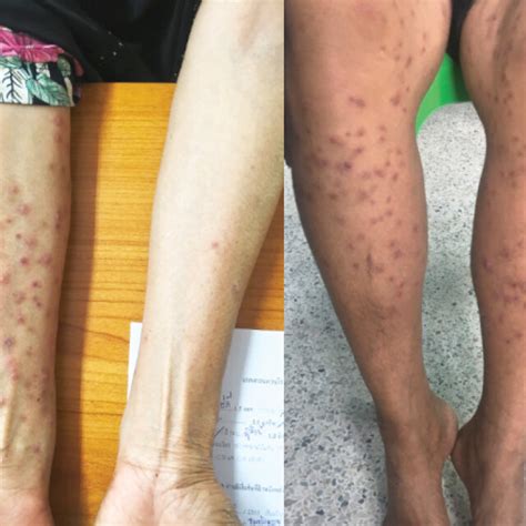 Cercarial dermatitis cases contracted from Chana district in October ...