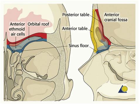 frontal sinus fractures ento key