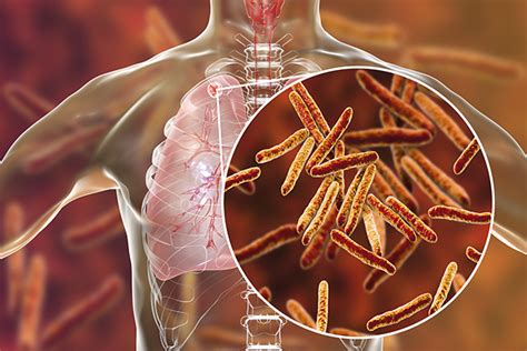 namibia committed  eradicating tb news  namibian