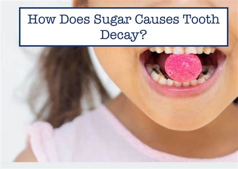 sugar  tooth decay