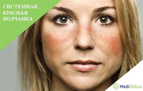 Красная волчанка: причины заболевания, симптомы и виды, методы лечения ...