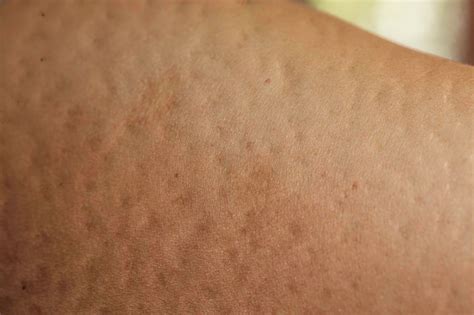 lipodystrophy pictures