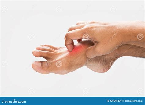 Have a itching foot. stock image. Image of ache, dermatitis - 270542439