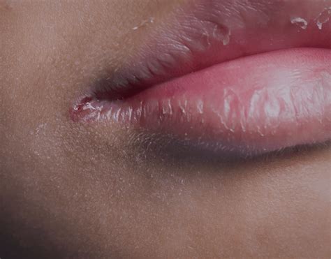 Angular Cheilitis: Causes, Symptoms, Treatment & More – NatruSmile