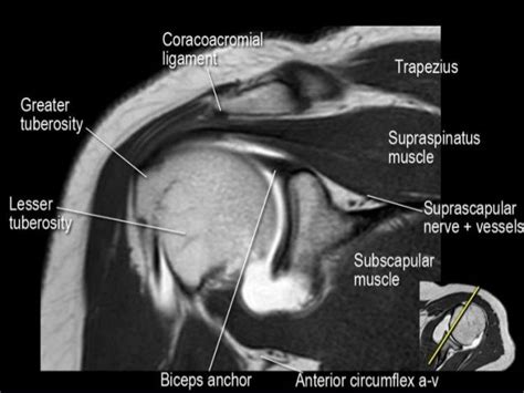 MRI of Shoulder anatomy