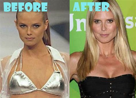 Heidi Klum Plastic Surgery Before and After Pictures - Lovely Surgery ...