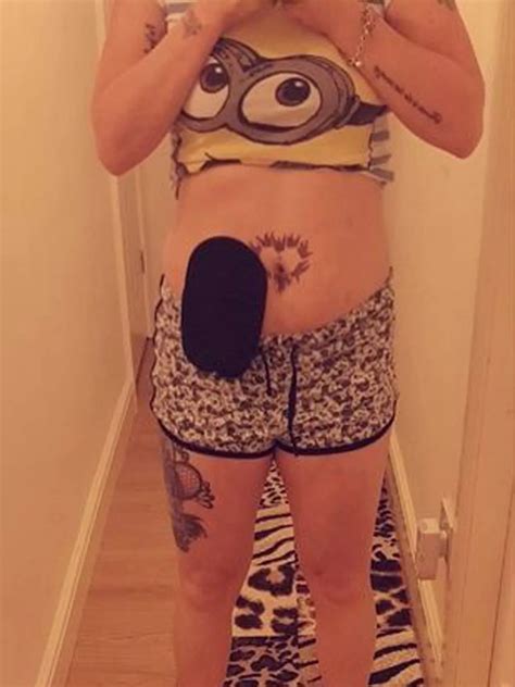 Severe bloating from bowel complications left woman 'looking pregnant