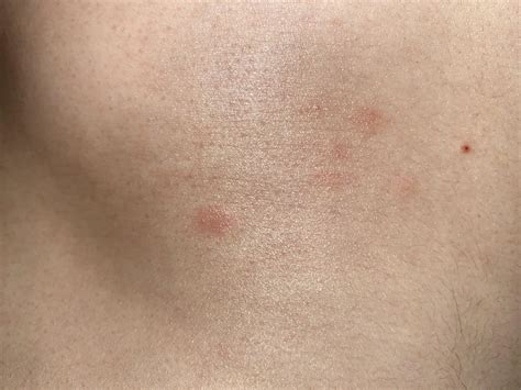 Painful Red Patch On Stomach at Jamie Gibb blog