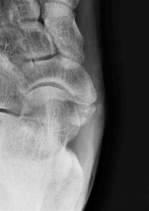 accessory bone alchetron   social encyclopedia