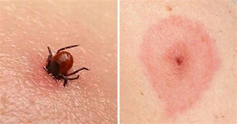 Como Fica A Picada De Carrapato Em Humanos - 12 tipos de picadas de insetos e como reconhecer qual deles o picou ...