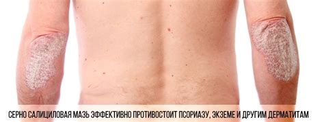 Серно салициловая мазь: инструкция по применению, цена, состав, от чего ...