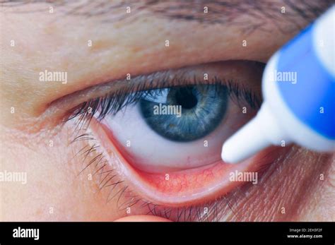 Implementation drug in conjunctival sac. Instill eye ointment Stock ...