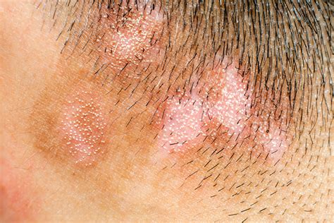 Comparing Devices to Assess Facial Pigmentary and Inflammatory