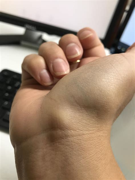 Brand New Cyst Popping Videos Youtube - Surveys Hyatt