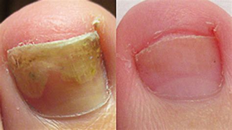 toenail fungus treatment options
