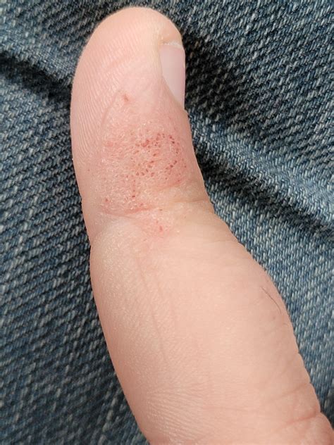 I have these small painful patches on 2 of my fingers. What can I do to